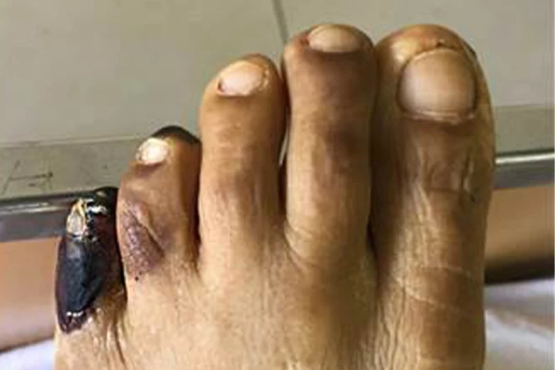 Gangrena