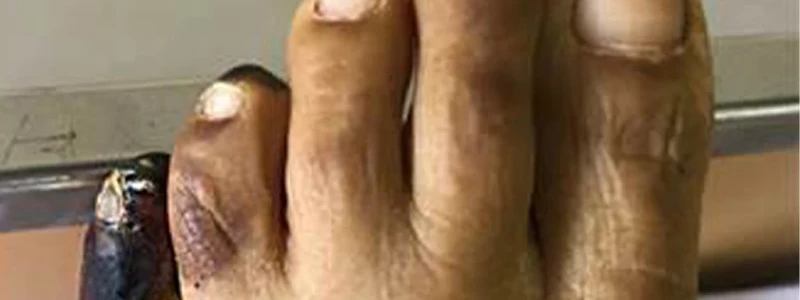 Gangrena